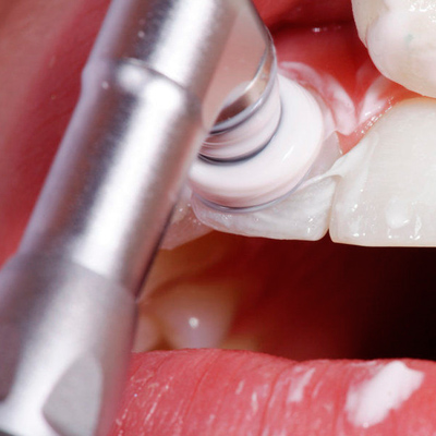 Фотография чистки зубов профессиональным аппаратом у стоматолога