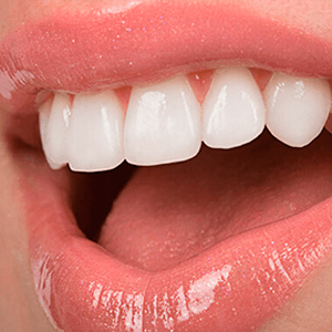 Керамические коронки на зубы - фото