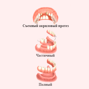 Полные и частичные акриловые зубные протезы - картинка